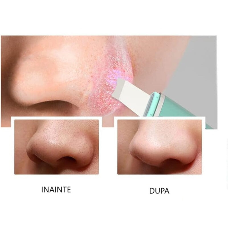 Aparat de curatare faciala cu ultrasunete, Horigen® C1 Pro
